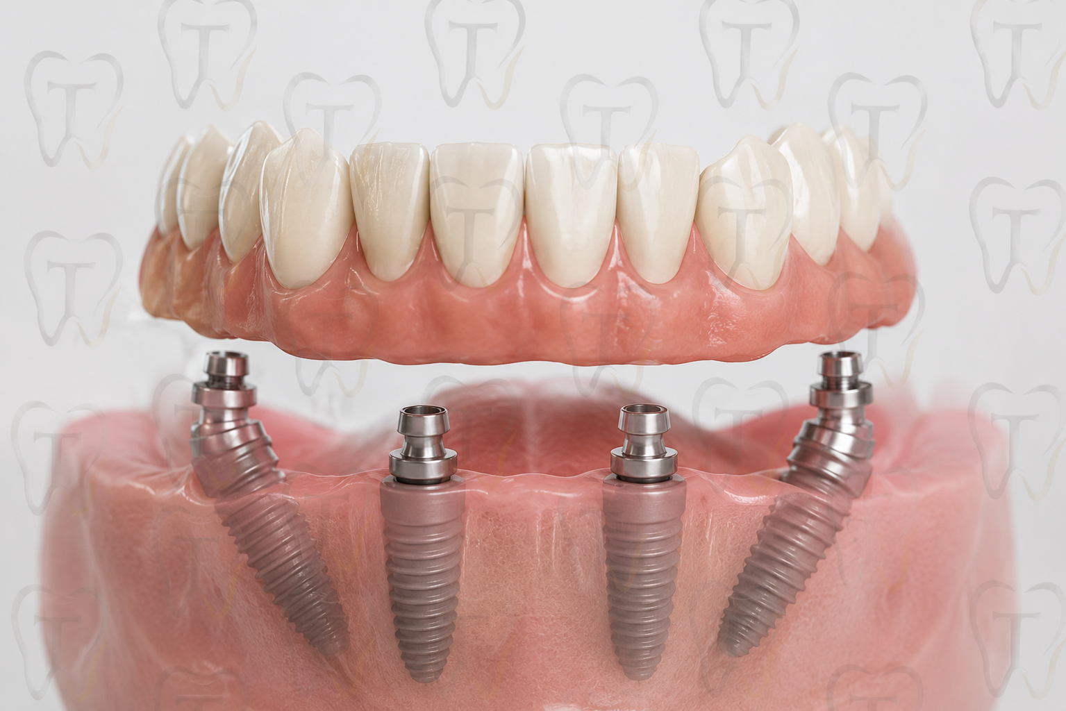 All-on-4 Nedir?
